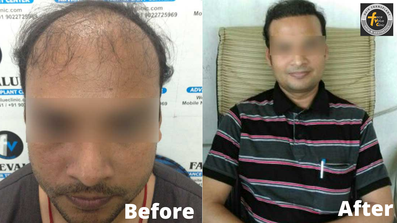 Before-DHI-Direct-Hair -Implantation-Hair-Transplant-in-chennai-Face-Value-Clinic