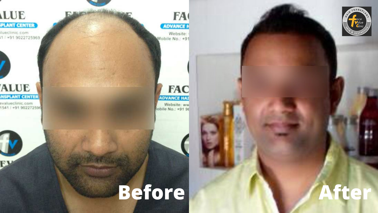 hair transplant clinic chennai hair transplant results