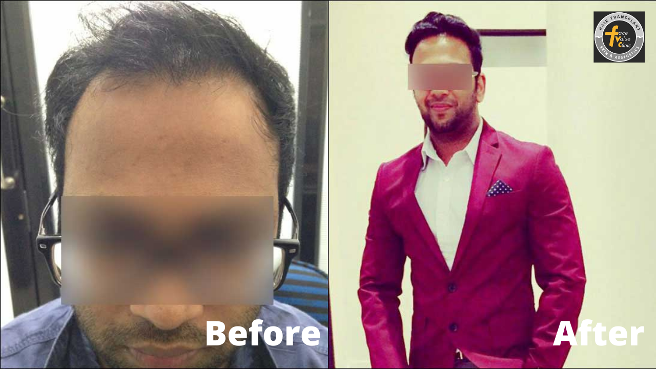 hair transplant clinic chennai hair transplant results