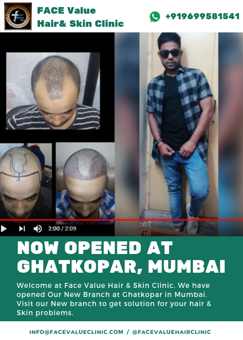 Hair transplant in ghatkopar