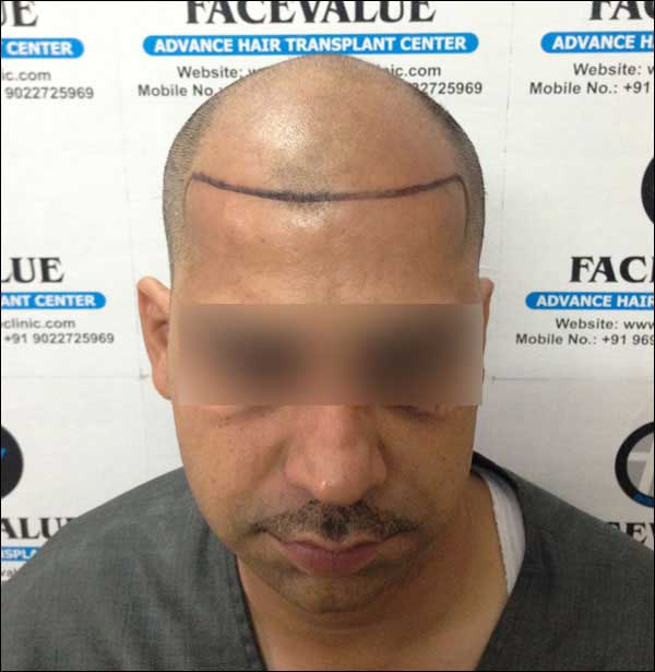 FUE-Hair-Transplant-Surgery-Face-Value-clinic-Patient-19-2