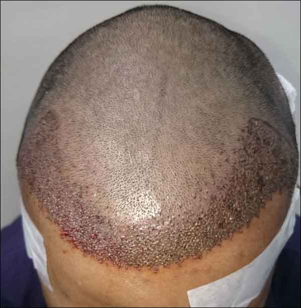 FUE-Hair-Transplant-Surgery-Face-Value-clinic-Patient-1-4