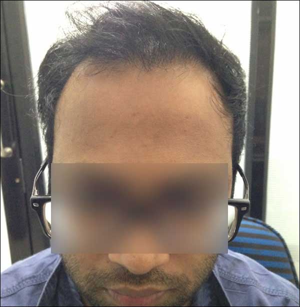 FUE-Hair-Transplant-Surgery-Face-Value-clinic-Patient-4-1