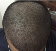During-Hair-Transplant-surgery-direction-2-face-value-hair-transplant-clinic-in-mumbai