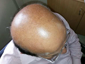 Poor-donor-area-case-1-b-face-value-hair-transplant-clinic-in-mumbai-india