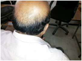 Poor-donor-area-case-1-face-value-hair-transplant-clinic-in-mumbai-india