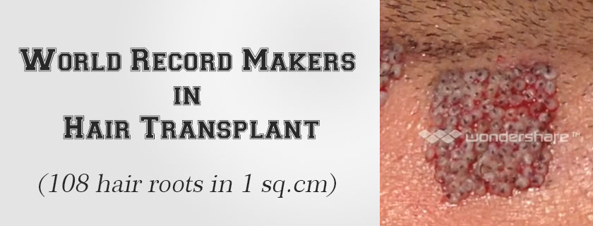 World record hair transplant maker | face value clinic hair transplant in mumbai