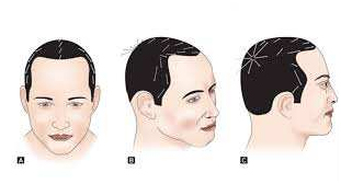 ur-photo-evaluation-hair-transplant-clinic-in-mumbai-face-value-1