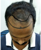 ur-photo-evaluation-hair-transplant-clinic-in-mumbai-face-value-2